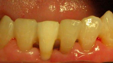 Replacing the natural missed own tooth with fibre splint