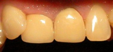 After (crowns and fillings)