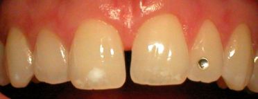 Dental jewel