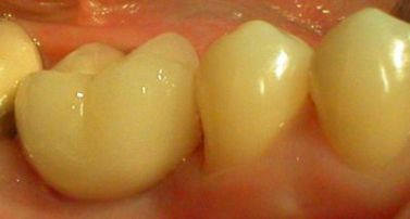 Implant (the left tooth)