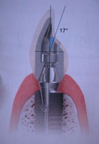 Behelyezett implantátum koronával (keresztmetszet)